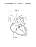 Minimally Invasive Method for Coronary Bypass and Other Treatments diagram and image