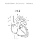 Minimally Invasive Method for Coronary Bypass and Other Treatments diagram and image