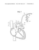 Minimally Invasive Method for Coronary Bypass and Other Treatments diagram and image