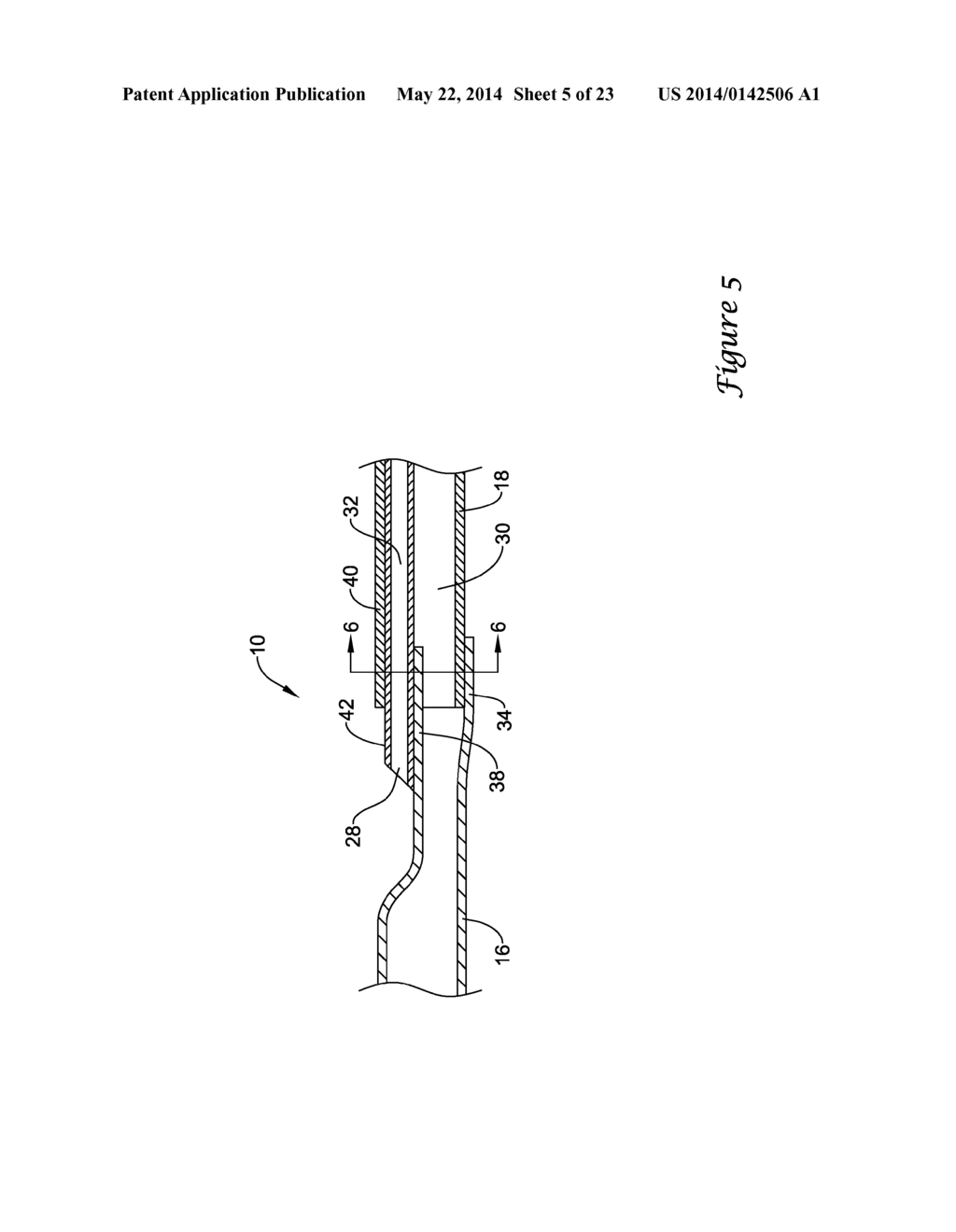 BALLOON CATHETER WITH IMPROVED PUSHABILITY - diagram, schematic, and image 06