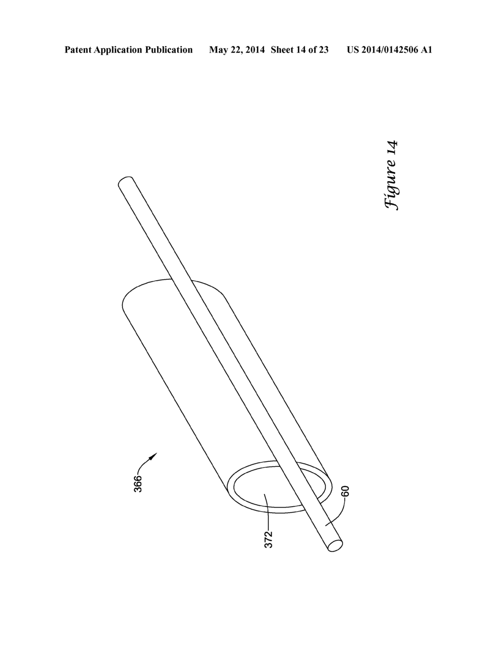 BALLOON CATHETER WITH IMPROVED PUSHABILITY - diagram, schematic, and image 15