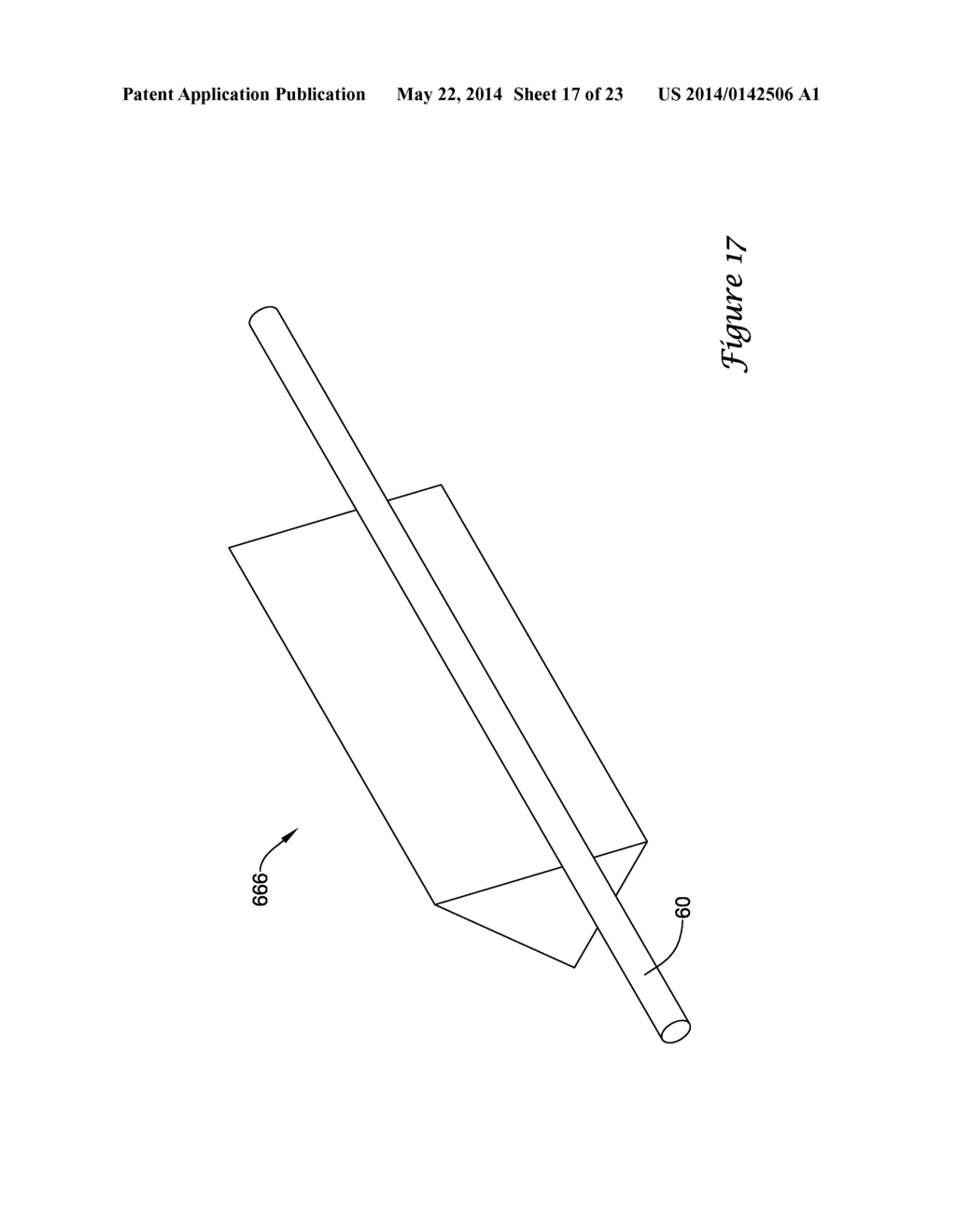 BALLOON CATHETER WITH IMPROVED PUSHABILITY - diagram, schematic, and image 18