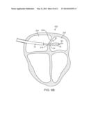 APPARATUS AND METHODS FOR RETRACTING A CATHETER BALLOON diagram and image