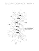 STERNUM FIXATION SYSTEM diagram and image