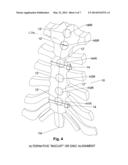 STERNUM FIXATION SYSTEM diagram and image