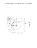 CUSTOMIZED PATIENT-SPECIFIC BONE CUTTING BLOCKS diagram and image