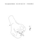 CUSTOMIZED PATIENT-SPECIFIC BONE CUTTING BLOCKS diagram and image