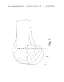 CUSTOMIZED PATIENT-SPECIFIC BONE CUTTING BLOCKS diagram and image