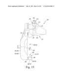 CUSTOMIZED PATIENT-SPECIFIC BONE CUTTING BLOCKS diagram and image