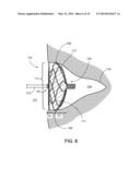 JOINT ASSEMBLY FOR MEDICAL DEVICES diagram and image