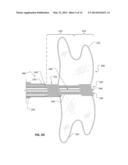 IMPLANTABLE MEDICAL DEVICE DEPLOYMENT SYSTEM diagram and image