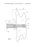 IMPLANTABLE MEDICAL DEVICE DEPLOYMENT SYSTEM diagram and image