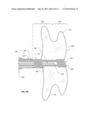 IMPLANTABLE MEDICAL DEVICE DEPLOYMENT SYSTEM diagram and image