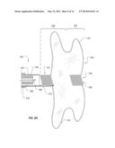 IMPLANTABLE MEDICAL DEVICE DEPLOYMENT SYSTEM diagram and image