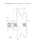 IMPLANTABLE MEDICAL DEVICE DEPLOYMENT SYSTEM diagram and image