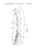 Orthodontic Toothbrush diagram and image