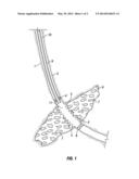 Methods of Enhancing Fracture Conductivity of Subterranean Formations     Propped with Cement Packs diagram and image