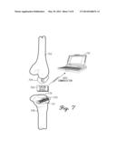 Orthopedic Screw For Measuring A Parameter Of The Muscular-Skeletal System diagram and image