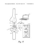 Orthopedic Screw For Measuring A Parameter Of The Muscular-Skeletal System diagram and image