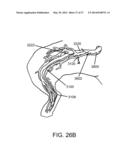 PERIPHERAL ARTERIALIZATION DEVICES AND METHODS OF USING THE SAME diagram and image