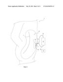 METHOD AND DEVICE TO TREAT KIDNEY DISEASE diagram and image