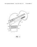 HIP FRACTURE DEVICE WITH STATIC LOCKING MECHANISM ALLOWING COMPRESSION diagram and image