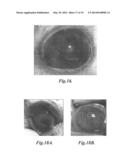 DEVICE AND METHOD FOR INTRAOCULAR DRUG DELIVERY diagram and image