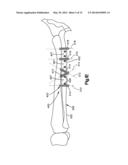 Surgical Guides from Scanned Implant Data diagram and image