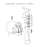 Surgical Guides from Scanned Implant Data diagram and image