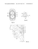 DEVICES AND METHODS FOR TREATING PAIN ASSOCIATED WITH TONSILLECTOMIES diagram and image