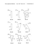 DEVICES AND METHODS FOR TREATING PAIN ASSOCIATED WITH TONSILLECTOMIES diagram and image