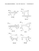 DEVICES AND METHODS FOR TREATING PAIN ASSOCIATED WITH TONSILLECTOMIES diagram and image