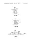 DEVICES AND METHODS FOR TREATING PAIN ASSOCIATED WITH TONSILLECTOMIES diagram and image