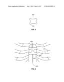 SYSTEMS AND METHODS FOR STERNUM REPAIR diagram and image