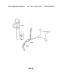 SYSTEMS AND METHODS FOR STERNUM REPAIR diagram and image