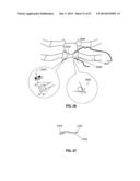 SYSTEMS AND METHODS FOR STERNUM REPAIR diagram and image