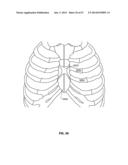 SYSTEMS AND METHODS FOR STERNUM REPAIR diagram and image