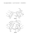 SYSTEMS AND METHODS FOR STERNUM REPAIR diagram and image