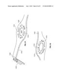 SYSTEMS AND METHODS FOR STERNUM REPAIR diagram and image