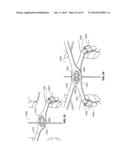 SYSTEMS AND METHODS FOR STERNUM REPAIR diagram and image