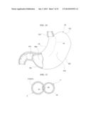 GASTRIC THERAPY SYSTEM AND METHOD FOR SUTURING GASTRIC WALL diagram and image