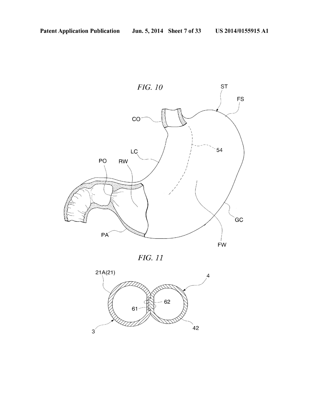 GASTRIC THERAPY SYSTEM AND METHOD FOR SUTURING GASTRIC WALL - diagram, schematic, and image 08