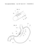 GASTRIC THERAPY SYSTEM AND METHOD FOR SUTURING GASTRIC WALL diagram and image