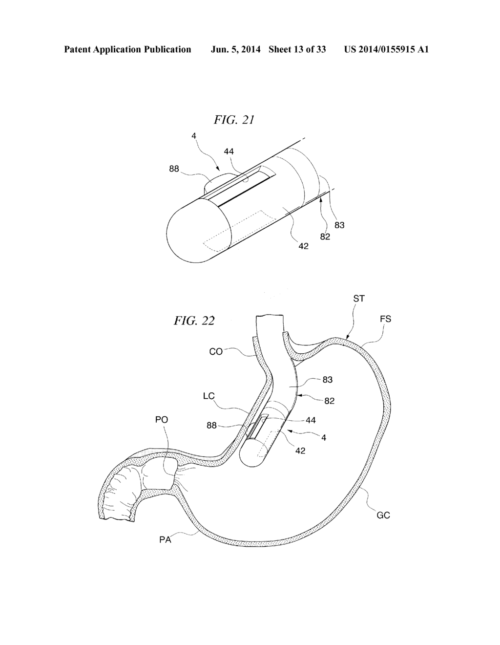 GASTRIC THERAPY SYSTEM AND METHOD FOR SUTURING GASTRIC WALL - diagram, schematic, and image 14