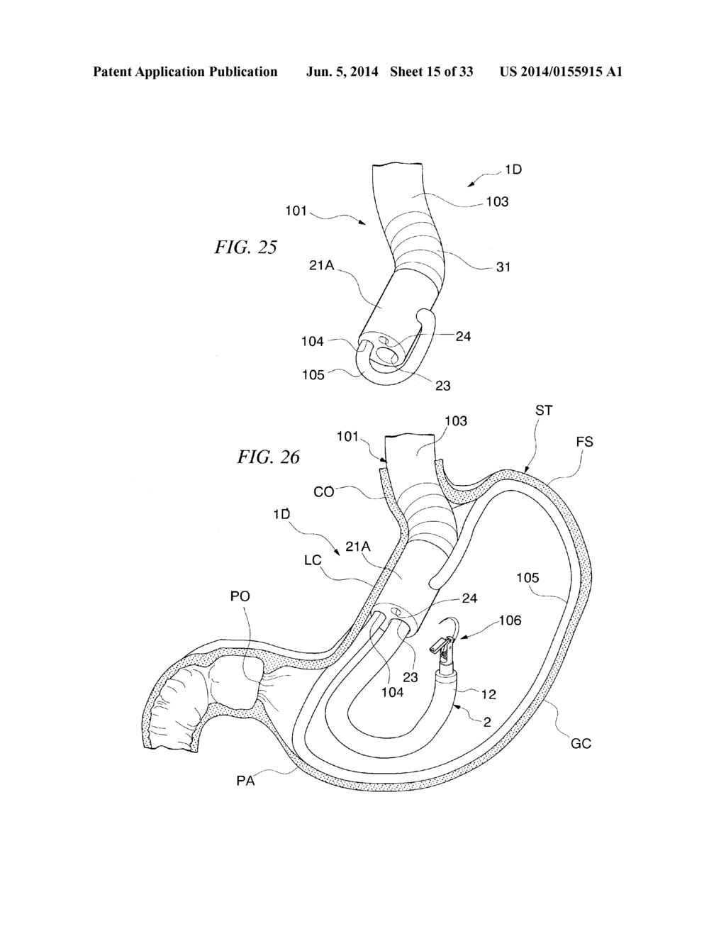 GASTRIC THERAPY SYSTEM AND METHOD FOR SUTURING GASTRIC WALL - diagram, schematic, and image 16