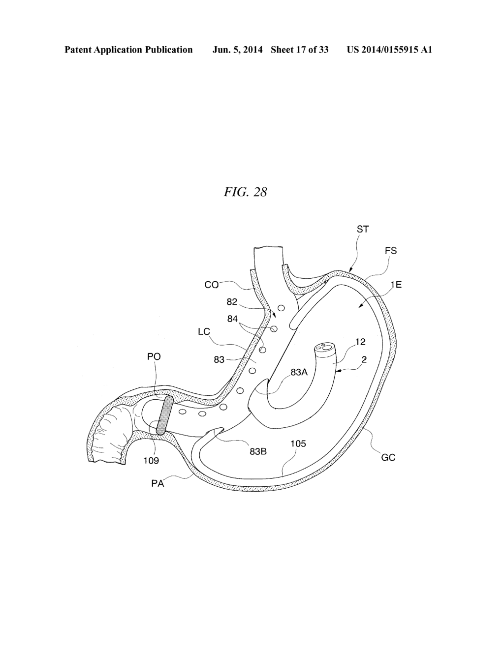 GASTRIC THERAPY SYSTEM AND METHOD FOR SUTURING GASTRIC WALL - diagram, schematic, and image 18