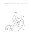 GASTRIC THERAPY SYSTEM AND METHOD FOR SUTURING GASTRIC WALL diagram and image