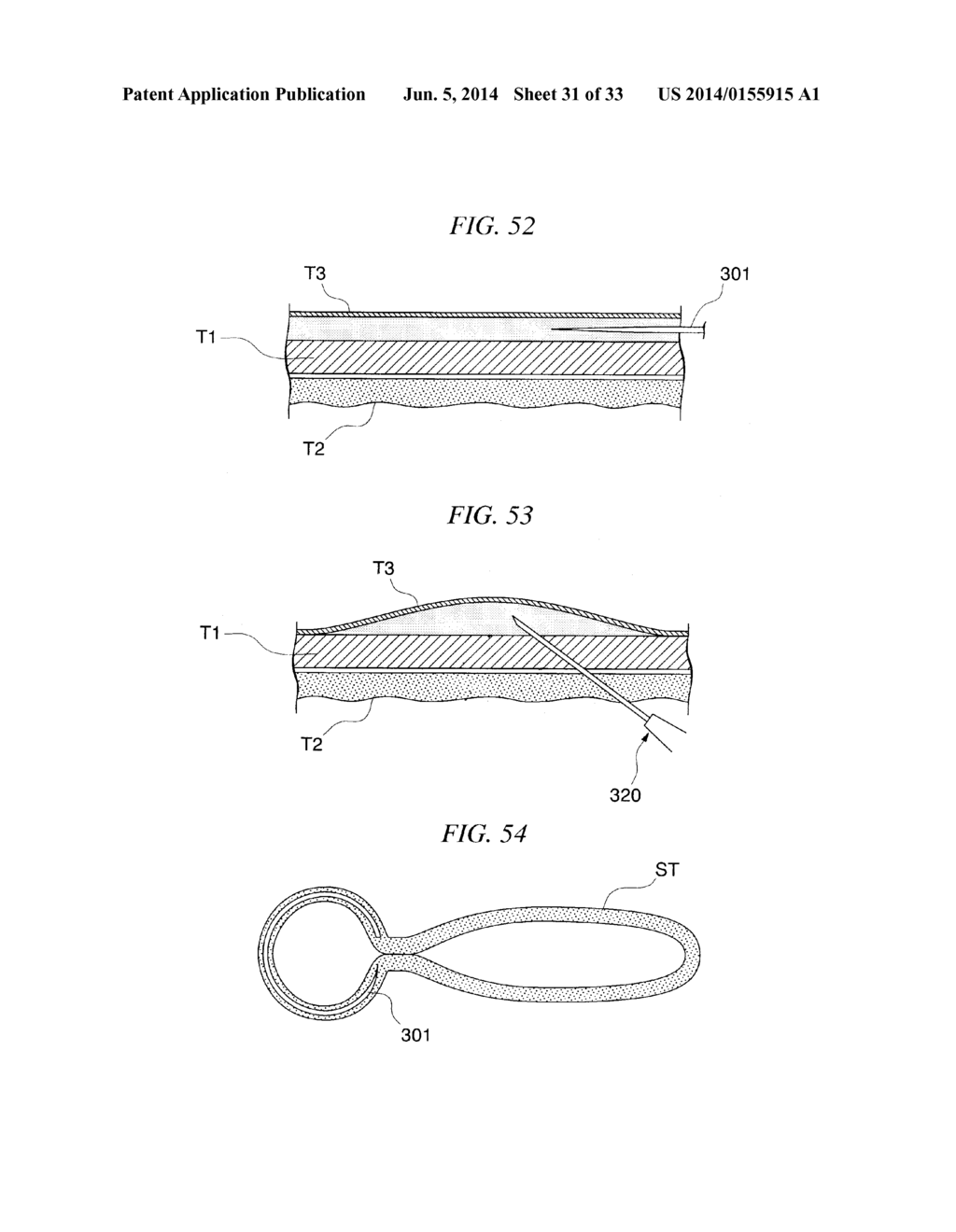 GASTRIC THERAPY SYSTEM AND METHOD FOR SUTURING GASTRIC WALL - diagram, schematic, and image 32