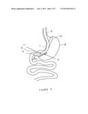Methods And Devices For Performing Gastroplasty diagram and image