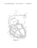 MRI CONDITIONALLY SAFE LEAD WITH LOW-PROFILE CONDUCTOR FOR LONGITUDINAL     EXPANSION diagram and image